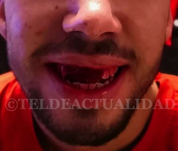 Imagen del jugador de la UD Las Remudas que perdió varias piezas dentales durante el partido (Foto TA)